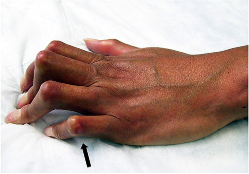 Figure 1 Sclerodactyly in SSC. The tightened skin extends beyond the metacarpophalangeal joints confirming the diagnosis of SSc. Also note contractures at the proximal interphalangeal joints and calcinosis cutis at the interphalangeal joint of the 5th digit (arrow).