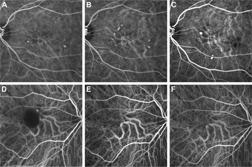 Figure 2 Indocyanine green angiogram of representative cases of type 1 and 2 PCV.