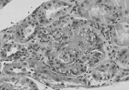 Figure 2. Second renal biopsy specimen showing glomerular necrosis and circumferential cellular crescent (hematoxylin and eosin stain ×400).