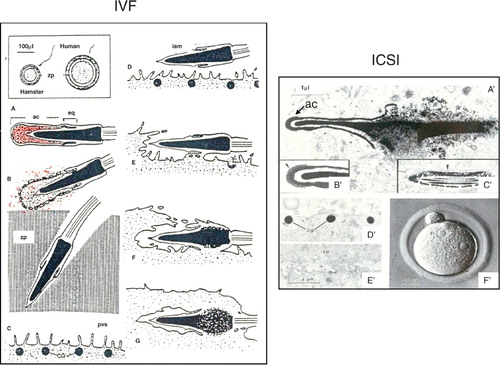 Figure 2.  Fertilization after IVF (diagrams) and ICSI (micrographs). The insert at the upper left of IVF shows the relative size of golden hamster and human gametes. Note that, in IVF the sperm acrosome and the plasma membrane do not enter the oocyte, whereas in ICSI both the sperm plasma membrane and the acrosome are injected into an oocyte. Abbreviations: ac: acrosomal cap region; cg: cortical granules; eq: equatorial segment of acrosome; iam: inner acrosomal membrane; pvs: perivitelline space; zp: zona pellucida. (A–G, from [Yanagimachi Citation1988]; A'–F', from [Kimura and Yanagimachi Citation1995]).