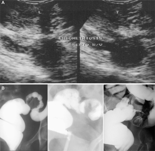 Figure 1 (A) Transvaginal ultrasound image showing endometriosis of the rectovaginal septum. (B) Radiologic images of a barium enema in patients with deep infiltrating endometriosis and intraluminal sigmoid tumor.