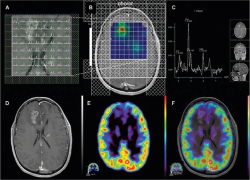 Figure 3 Magnetic resonance spectroscopy.Notes: Anaplastic astrocytoma, WHO grade III. Multiple-voxel spectra coregistered with post-contrast T1-weighted MRI (A). Map of Cho/Cr demonstrates a focus of signal intensity in the right frontal lobe (B). MRSI signal intensity is presented on a rainbow color scale where blue-green is normal background and bright red corresponds to greatly elevated signal intensity. Spectral analysis of the voxel demonstrating maximal Cho/Cr ratio (C). T1-weighted MRI (post-contrast) demonstrating enhancing lesion in the right frontal lobe (D). 18F-FDG PET scan shows a focus of increased tracer activity greater than white matter in the right frontal lobe (E). 18F-FDG PET image coregistered with post-contrast T1-weighted MRI (F). Reproduced with permission from John Wiley and Sons. Imani F, Boada FE, Lieberman FS, Davis DK, Deeb EL, Mountz JM. Comparison of proton magnetic resonance spectroscopy with fluorine-18 2-fluoro-deoxyglucose positron emission tomography for assessment of brain tumor progression. J Neuroimaging. 2012;22(2):184–190.Citation80 Copyright © 2010 by the American Society of Neuroimaging.Abbreviations: Cho/Cr, choline/creatine; MRI, magnetic resonance imaging; MRS, magnetic resonance spectroscopy; NAA, N-acetylaspartate; WHO, World Health Organization; FDG, 2-fluorodeoxyglucose; PET, positron emission tomography.