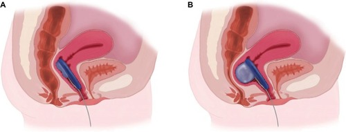 Figure 2 The vaginal bowel control insert deflated (A) and inflated (B).