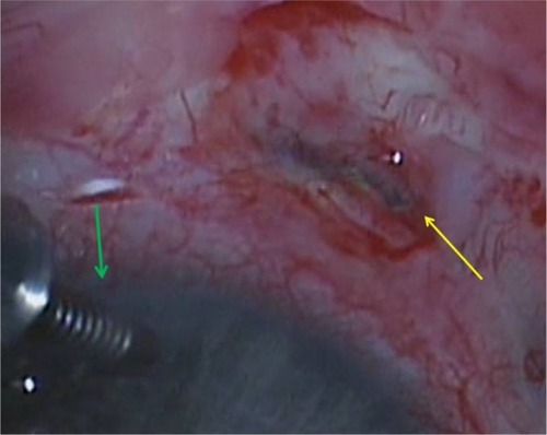 Figure 1 Intraoperative photo of the right eye.