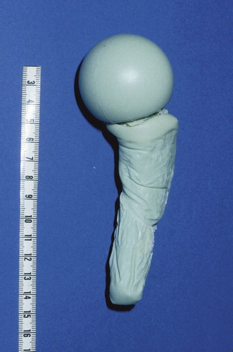 Figure 5. After removal of the glove, the cement mantle around the stem of the spacer shows an almost exact anatomical copy of the proximal part of the femur.
