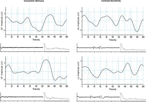 Figure 3 Diopsys PERG trace of a patient from group HM. The right eye of this participant was included in the study and had spherical equivalent of −10.87D, visual field mean deviation −17.69dB and average retinal nerve fibre layer thickness of 56µm. Left: Concentric stimulus (ConStim) protocol with 24° (top) and 16° (bottom) settings. Signal quality was good (96dBµV). Right: Contrast Sensitivity (ConSen) protocol with high contrast (Hc) (top) and low contrast (Lc) (bottom) settings. Signal quality was similarly good (86dBµV).