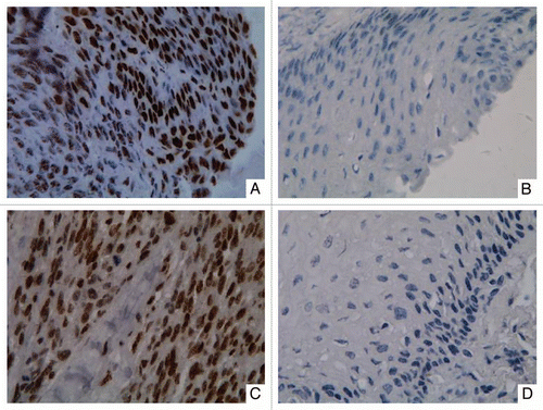 Figure 3 Representative immunohistochemical staining results for DNMT3b protein in two patients with ESCC. Strong nuclear expression was seen in the layer of epithelium in ESCC tissues (A and C). Negative staining was observed in paired non-tumor tissues (B and D). (Original magnification ×400 in A–D).