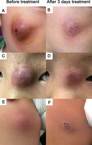 Figure 2 Case1: A skin abscess on the face of a 3-year-old child before (A) and after (B) 3 days of fire needle combined therapy. Case 3: A skin abscess on the nasal root of a 7-year-old child before (C) and after (D) 3 days of fire needle combined therapy. Case 13: A skin abscess on the buttock of a 1-year-old child before (E) and after (F) 3 days of fire needle combined therapy.