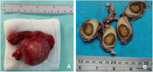 Figure 3 Macroscopic anatomy findings of the left testis from the patient of Case 1 (A) and Case 2 (B). Note a well circumscribed yellowish-brownish mass inside the testis.