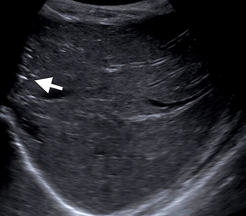 Figures 4. Abdominal sonography. Representative sagittal image of the liver demonstrates echogenic foci with posterior acoustic shadowing in the peripheral hepatic dome, compatible with portal venous gas. On follow up the next day, this finding had resolved.