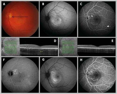 Figure 1 Clinical features visible on multimodal imaging of the left eye of a 37-year-old male patient with aCSC. (A) Color fundus photograph showing small pigment clustering in the macula and a silhouette of the serous retinal detachment. The arrow indicates the scanning plane, which is depicted on the SD-OCT. (B) FAF image at diagnosis showing a speckled (ie, granular) hyper-autofluorescent lesion at the site of the serous neuroretinal detachment. (C) FA imaging revealed a single “hot spot” of leakage and a typical small detachment of the RPE above the inferior retinal arcade (arrow). (D) An SD-OCT scan at diagnosis revealed SRF accumulation, a thickened choroid, and subretinal debris, presumably consisting of non-phagocytized photoreceptor outer segments. (E) SRF resolved spontaneously within a few weeks. (F) The areas of hyper-fluorescence on mid-phase ICGA revealed diffuse choroidal hyperpermeability that was larger than the leakage site visible on FA. A recurrent episode 1.5 years later was treated with two subthreshold micropulse diode laser but did not result in resolution of the SRF. Eventually, half-dose photodynamic therapy resulted in resolution of the SRF (G and H). At the patient’s final visit 11 months later, hyper-autofluorescent and hypo-autofluorescent abnormalities were visible (G), and FA imaging revealed a slightly enlarged area of RPE alterations (H).Abbreviations: aCSC, acute central serous chorioretinopathy; ICGA, indocyanine green angiography; FA, Fluorescein angiography; FAF, Fundus autofluorescence; SD-OCT, spectral-domain optical coherence tomography; SRF, subretinal serous fluid; RPE, retinal pigment epithelium.