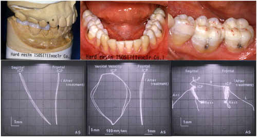 Figure 6. Posterior onlays were fabricated and seated using Panavia EX (top). Jaw movements were recorded using MKG K5 (bottom). Smooth movement to ICP with undisrupted velocity was observed.