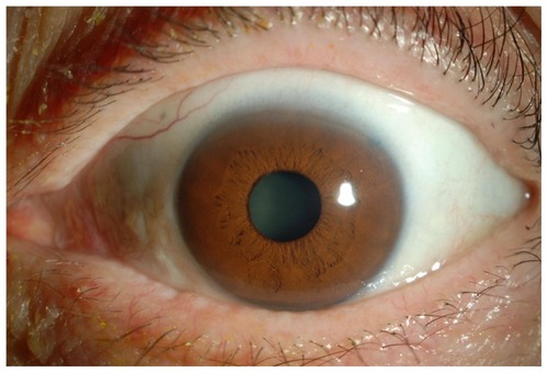 Figure 2 Anterior segment of the left eye at initial visit in case 1.