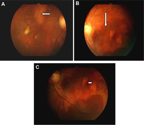 Figure 2 Fundus findings in patient 8 with idiopathic polypoidal choroidal vasculopathy. Right eye (A) with resolved subretinal blood and macular degeneration. (A) subretinal orange lesions (medium arrow); The left eye (B) shows fresh subretinal hemorrhage (long arrow); and (C) retinal pigment epithelial detachment (short arrow). Note the absence of drusen seen in age-related macular degeneration.
