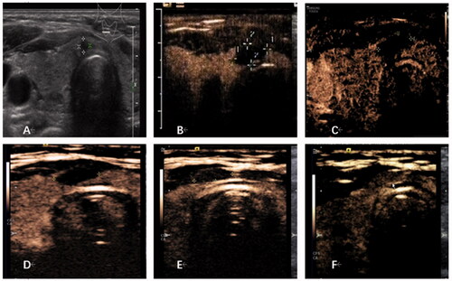 Figure 2. Imaging evaluation of one patient. (A) B-mode ultrasound revealed a hypoechoic nodule on the thyroid isthmus, 3 × 3 × 4 mm in size. (B) Contrast-enhanced ultrasound (CEUS) examination was performed after RFA, and the ablation area was 14 × 6 × 15 mm. (C) One month after ablation, CEUS showed that the ablation area was 10 × 4 × 10 mm, with a volume reduction rate of about 68%. (D) At 3 months after ablation, CEUS showed that the ablation area was 8 × 4 × 7 mm, with a volume reduction rate of about 82%. (E) At 6 months after ablation, CEUS showed that the ablation area was 8 × 3 × 6 mm, with a volume reduction rate of about 89%. (F) At 12 months after ablation, the ablation area was completely absorbed, and the isthmus was uniformly enhanced by contrast-enhanced ultrasound.