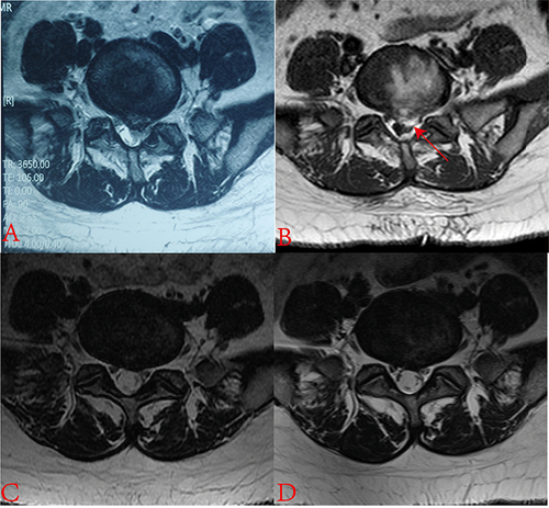 Figure 3 Preoperative, 1 h, 6-month, and 12-month postoperative MRI scans of patient 1. (A) Preoperative T2 weight scan depicts a central disc herniation in L5-S1. (B) The postoperative T1 weight scan with the red arrow pointing to the annulus fibrosus rupture. (C and D) Postoperative T2 weight scans at 6 and 12 months, respectively, display that the annulus fibrosus has occurred in the operated segment, but the annulus fibrosus remains protruded.