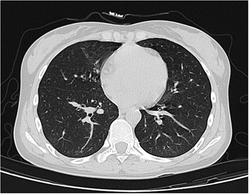 Figure 3 CT scanning showed significant improvement of the pulmonary lesions.