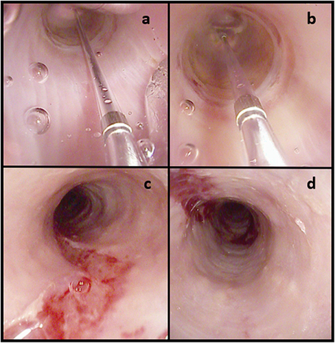 Figure 2 (a and b) Endoscopic dilatation with through-The-scope pneumatic balloon of a distal esophageal ring; panels (c and d) mucosal trauma after Savary dilatation in a narrow-caliber esophagus. In (a and b), the transparent pneumatic balloon is filled with saline and inflated, which allows to exert a radial pressure and obtain the dilatation of the esophageal stricture. (c and d) show the mucosal tear that results from the dilatation of the stricture. This is the intended outcome when performing stricture dilatations.