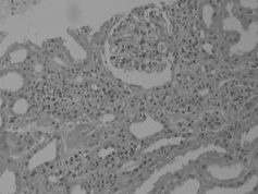 Figure 3. Glomerulus in the field shows focal mesangial proliferation with neutrophil infiltration and fibrin deposition. (Hematoxylin and Eosin, × 40).