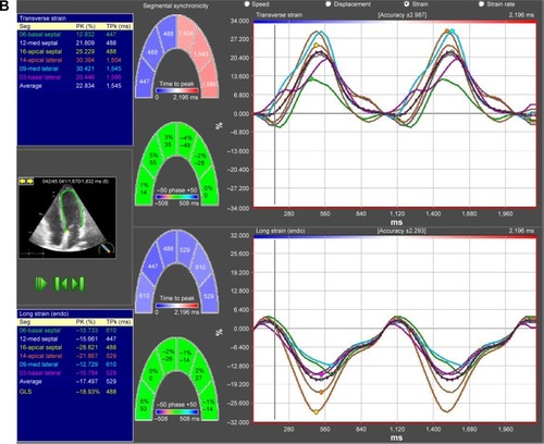 Figure 2 Left ventricular longitudinal strain analysis, visualized by two-dimensional speckle tracking echocardiography.Notes: Deformation imaging of the left ventricle was performed in both COPD patients (A) and controls (B), which showed significant differences in global and apical longitudinal deformation properties.Abbreviations: Long, longitudinal; Max, maximum; Seg, segments; PK, peak; TPk, time to peak; GLS, global longitudinal strain; endo, endocardial.