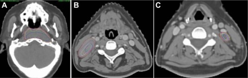 Figure 1 The gross tumor volume of the primary tumor, as well as of the large and small lymph nodes on planning CT and six repeat CTs.