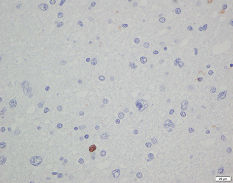 Figure 6 Immunohistochemistry staining for Ki67 (diffuse astrocytoma) showed low expression.