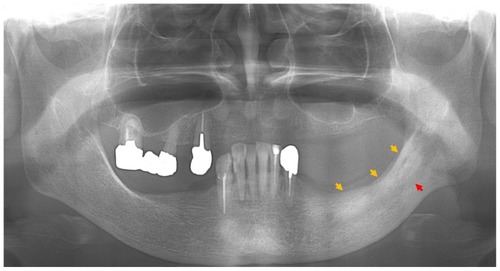 Figure 1 Panoramic radiograph at first visit, showing a ground-glass appearance (yellow arrows) from the left premolar to the mandibular ramus region and enlarged canals of the left mandible (red arrow).