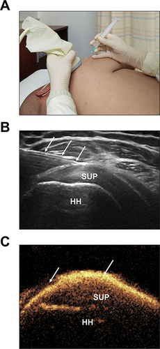 Figure 2 Detailed procedure of PUSB examination. (A) In-plane approach during PUSB examination. (B) The ultrasound guidance of the puncture needle (↓↓↓) into the SASD. (C) Strong echogenicity of the contrast agent in the SASD (↓↓).
