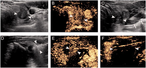 Figure 2. A 40-year-old woman with papillary thyroid microcarcinoma in the right lobe was treated with microwave ablation. Contrast-enhanced ultrasound showed partial ablation of the tumor. Complementary ablation was performed in this patient. (A) Pre-ablation, B-mode ultrasound shows hypoechoic target tumor (arrowheads); (B) Pre-ablation, contrast-enhanced ultrasound shows hypo-enhancement pattern (arrowheads); (C) Hydrodissection technique (arrows) was used to protect the vagus nerve and carotid artery surrounding the tumor (arrowheads); (D) Hyperechoic pattern in the tumor (arrowheads) during ablation; (E) Post-ablation, the CEUS shows partial ablation of the tumor (arrowheads); (F) After complementary ablation, the CEUS shows no enhancement (arrowheads) in the tumor.