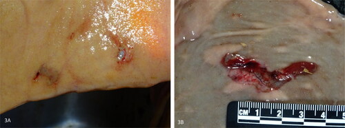 Figure 3. Hemorrhagic Bowel syndrome early-stage lesions, small intestine, bovine. (a) Two clustered erosions with minimal hemorrhage. (b) Laceration-like lesion with a detached mucosal flap and hemorrhage.