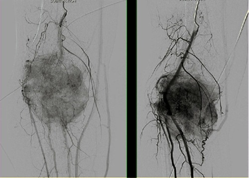 Figure 6 The angiogram showed a poor angiographic response, which indicated as persistence or even more concentration of tumor vascularity and tumor stain.