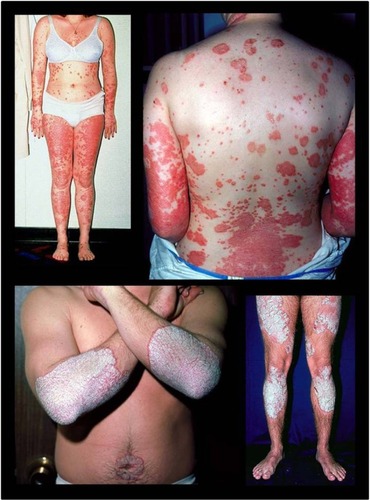 Figure 1 Plaque psoriasis.