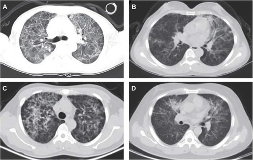 Figure 2 Lung CT showed diffuse, plaque-like, ground-glass opacities in both lungs. (A) A 37-year-old male patient underwent RT after 4 years of hemodialysis, and PCP occurred 4 months after surgery. CT showed plaque-like, grid-like, high-density shadows and clouding in both lung fields, with blurred edges. (B) A 40-year-old female patient underwent RT after 1 year of peritoneal dialysis, and PCP occurred 5 months after surgery. CT showed increased multiple plaque-like opacities in the lungs, and the edges were unclear. (C) A 36-year-old male patient underwent RT after 1 year of hemodialysis, and PCP occurred 3 months after surgery. CT showed diffuse, ground-glass, high-density shadows in both lungs, with unclear edges. (D) A 34-year-old male patient underwent RT after 2 years of hemodialysis, and PCP occurred 4 months after surgery. CT showed scattered, plaque-like opacities in both lungs with unclear edges.