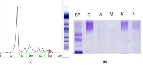 Figure 4. The results of the second serum protein electrophoresis and immunofixation electrophoresis (March 10, 2021). (A) shows that there was one M protein in the SPE. (B) shows that the report of the SIFE was IgG κ immunotyping.