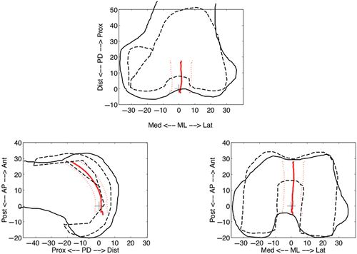 Figure 7. The post-arthroplasty patellar trajectory (mean and standard deviation) also had minimal mediolateral deviation throughout flexion. All three surgeons resected less from the tibia than the insert size, thus raising the joint line. This resulted in a more proximal femoral component, more distal contact of the patella on the femoral component, and a longer portion of the trajectory within the notch. This is called pseudo patella baja, as the distal patellar contact is not due to shortening of the patellar tendon. Geometric data for the femoral component were obtained from the manufacturer; the schematic shows a typical placement of the component on the femur. [Color version available online.]