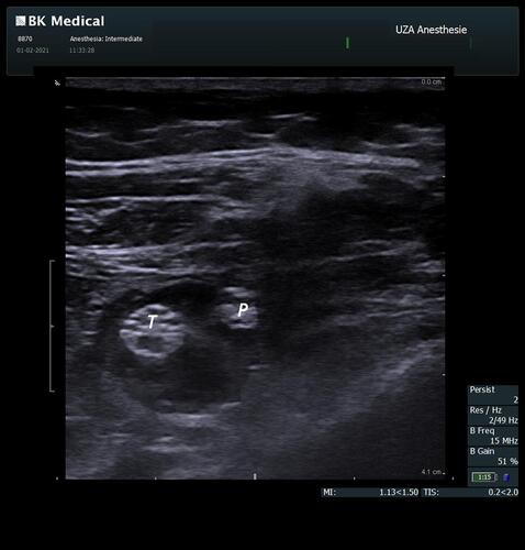 Figure 2 Injection of fluid in between the tibial (T) and peroneal (P) nerve.