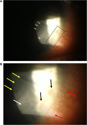Figure 1 (A) Peripheral sterile infiltrates and diffuse lamellar keratitis in the inferonasal area of the right cornea. Yellow arrows: Area of diffuse lamellar keratitis with “sands of Sahara” appearance. White arrow: Edge of the small incision lenticular extraction (SMILE) cap. Red arrows: Limbal inflammation. Black rectangle: Peripheral sterile (catarrhal) infiltrate of marginal keratitis. Slit lamp light has overexposed the area. (B) Enlarged view of panel A. Yellow arrows showing diffuse lamellar keratitis. White arrow showing the edge of the SMILE cap. Red arrows showing limbal inflammation. Black arrows showing the catarrhal infiltrates.