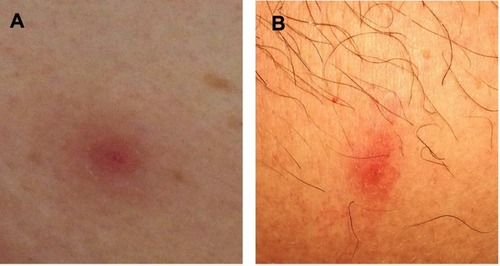 Figure 1 Skin lesions of the abdomen in Case #1 (A) and leg in Case #4 (B). See text for the description.