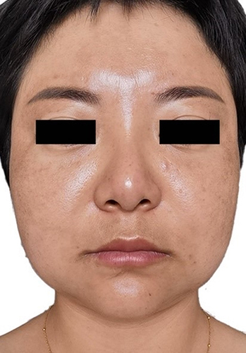 Figure 4 Photograph of the patient after 4 months of treatment at home with minocycline (100mg/ night) and 0.03% tacrolimus cream.