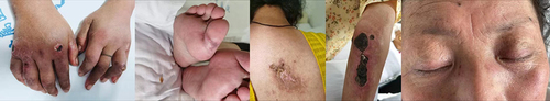 Figure 3 Patient’s skin condition on 2023-07-01.