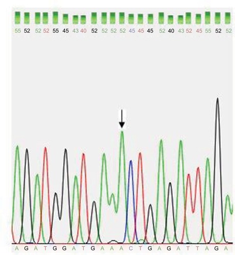 Figure 3 Partial DNA sequence chromatogram for exon 3 of the DAZL gene shows normal A allele (arrow).