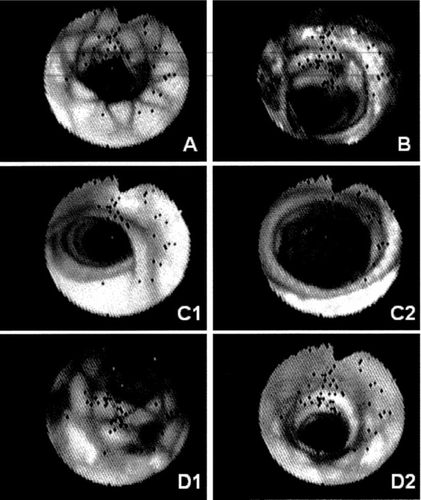 Figure 16 Illustrations in endoscopy of the luminal surface of the stent-grafts. A) distal end of the transrenal stent constriction in a stent-graft. B) constriction at the anchorage of Module B in Module A with variable levels of thrombotic encroaching in a stent-graft. C1, C2) distal section of the unsupported segment of Module A close to the anchorage of module B. D1, D2) scattered mural thrombi in a stent-graft 97 days after deployment in a 115 days prosthetic aneurysm.