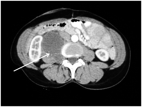Figure 8. CT slice showing psoas muscle invasion. The mucinous appendiceal adenocarcinoma invaded extensively along the psoas muscle.