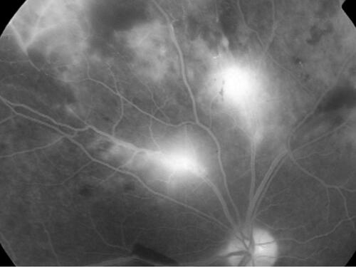 Figure 5 Fluorescein angiography showing active TRV. In contrast to Figure 4, active vasculitis shows leakage from the vessel wall: more intense from the venules proximal to the optic nerve head, and less intense from the peripheral venule in the left upper corner, but with adjoining capillary nonperfusion. As the active vasculitis regresses, the occlusive phase starts from periphery in the same eye.