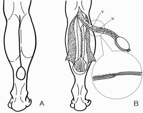 Figure 1. A. After estimating the size and shape of the recipient site, the pivot point and pedicle length were determined and the donor site was designed. The fasciocutaneous flap was to be centered on an imaginary line on the posterior calf, thereby indicating the course of the lesser saphenous vein (V) and sural nerve (N). B. At the midpoint of the lower leg, the sural nerve penetrates the deep fascia and courses between the two heads of the gastrocnemius muscle. The neurovascular structures may adhere to the surrounding tissues at this point, thereby necessitating careful dissection.