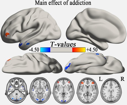 Figure 1 The main effect of group (addiction) on the typical frequency band (GRF correction, voxel-level p<0.01 and cluster-level p<0.05). The cool color indicates brain regions with decreased VMHC, and the warm color indicates brain regions with increased VMHC. The left side of the picture represents the left side of the brain.