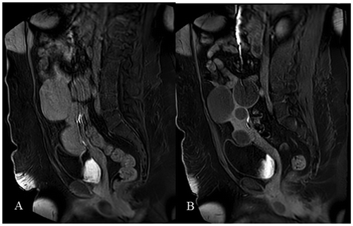 Figure 1. (A) Presents contrast-enhanced MRI of the fibroid prior to UFE. (B) Presents the same fibroid after UFE with complete fibroid infarction (100%) without residual contrast enhancement. Category 1.