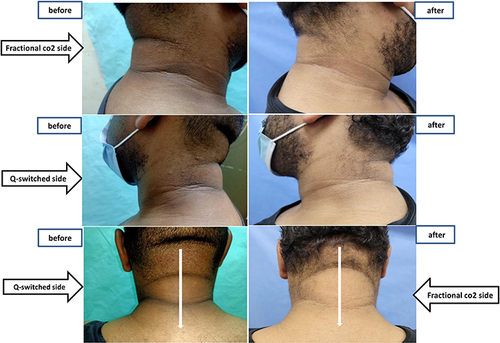 Figure 5 Patient 2 clinical photos before and after treatment.