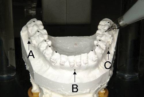 Figure 4. Three-dimensional digitizing of centric stops and reference points. A, B and C are the reference spheres impressed on the lower cast model.