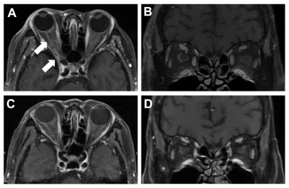 Figure 2 Enhanced fat-suppressed T1-weighted magnetic resonance images. (A and B) before steroid therapy. (C and D) after intravenous prednisolone. (A and C) are horizontal sections. (B and D) rare coronal sections. Enhancement of the optic nerve sheath and orbital apex can be seen before treatment (arrows).